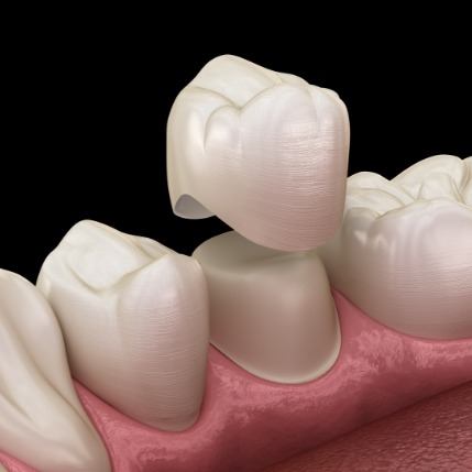 Animated dental crown being fitted over a tooth for restorative dentistry