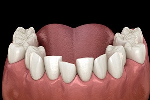 Illustration of crooked teeth