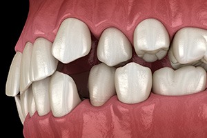 Illustration of gapped teeth