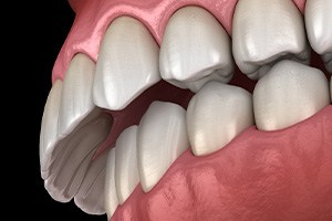 Illustration of an overbite