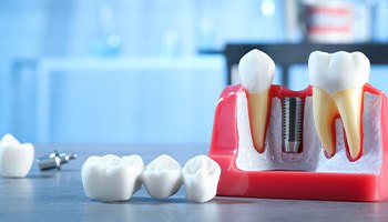 Dental bridge and crown next to model implant on table
