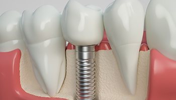 Illustration of dental implant between natural teeth