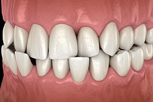 Illustration of a crossbite