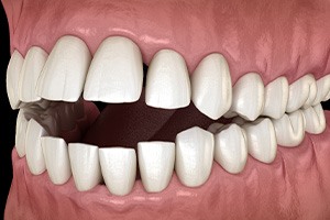 Illustration of an open bite