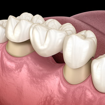 Illustration of traditional dental bridge being placed on teeth