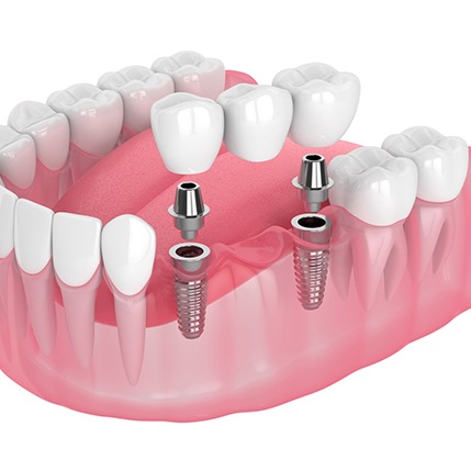 Illustration of implant bridge for lower dental arch