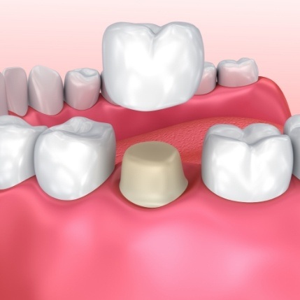Animated dental crown in Catonsville being fitted over a tooth