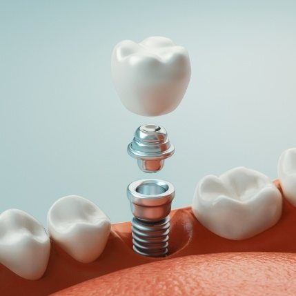 Animated dental implant with crown replacing a missing tooth