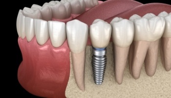 Animated dental implant with dental crown