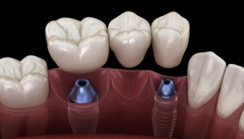 Animated dental bridge being placed over two dental implants