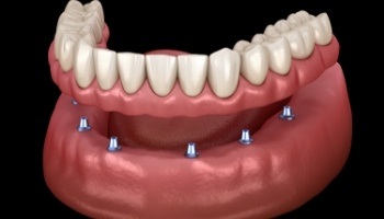 Animated implant denture being placed over six dental implants