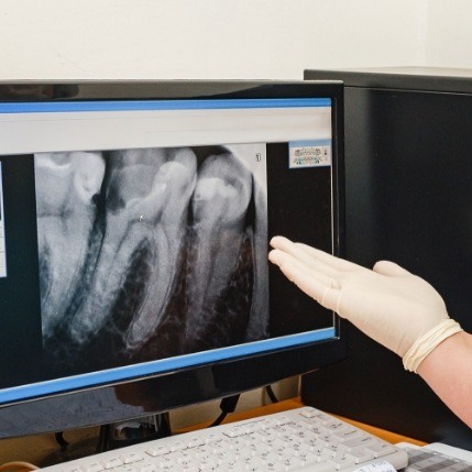 Dentist gesturing to computer screen showing digital dental x rays