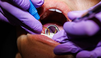 Catonsville dentist explaining gum disease treatment plan