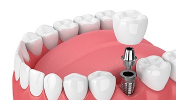 An up-close view of a single dental implant