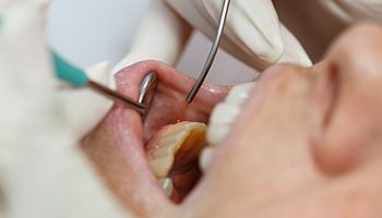 patient performing laser dentistry on patient 