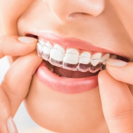 Closeup of patient putting Invisalign aligner on top teeth