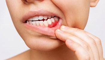 Patient pulling back lip to show red gums