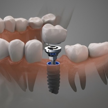 Animated dental implant replacing a missing tooth