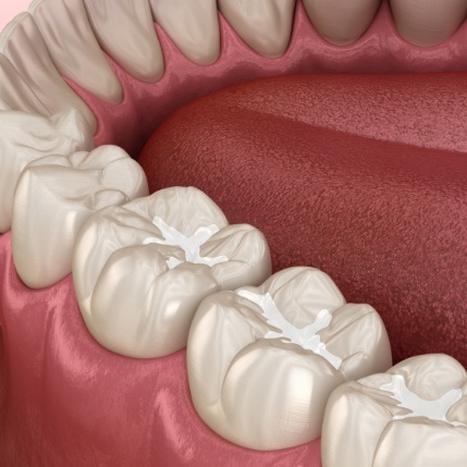 Animated row of teeth with tooth colored fillings