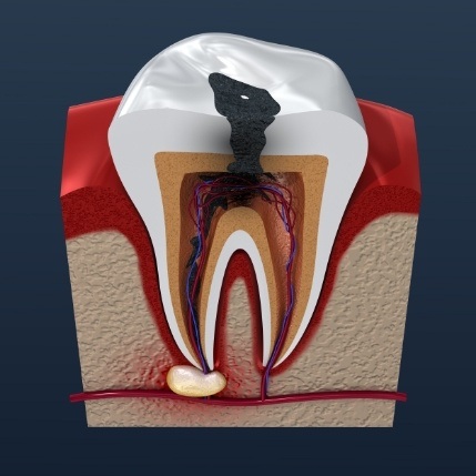 Animated infected tooth that needs root canal treatment