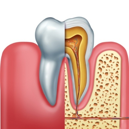 Animated damaged tooth that needs root canal treatment in Catonsville