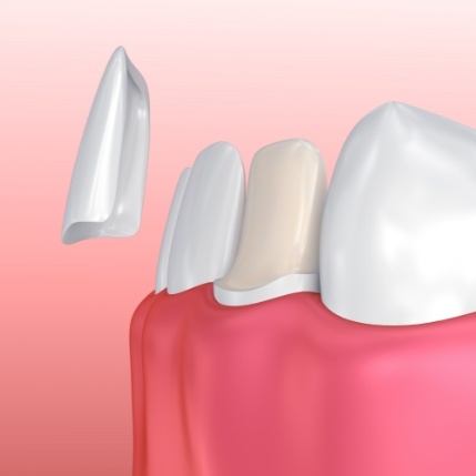 Animated veneer being placed over the front of a tooth
