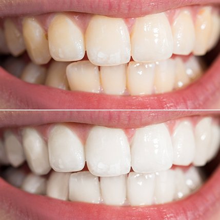A smile before and after professional teeth whitening