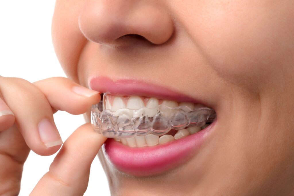 Nose-to-chin closeup of woman removing Invisalign from upper arch